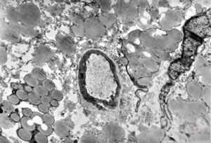 M,35y. | duodenum … lipid malabsorption - susp. hypo-beta-lipoproteinemia M,35y. | duodenum … lipid malabsorption - susp. hypo-beta-lipoproteinemia
